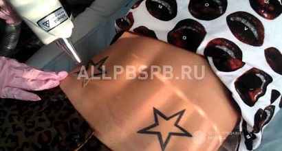 Продажа:  мобильный салон удаления татуировок